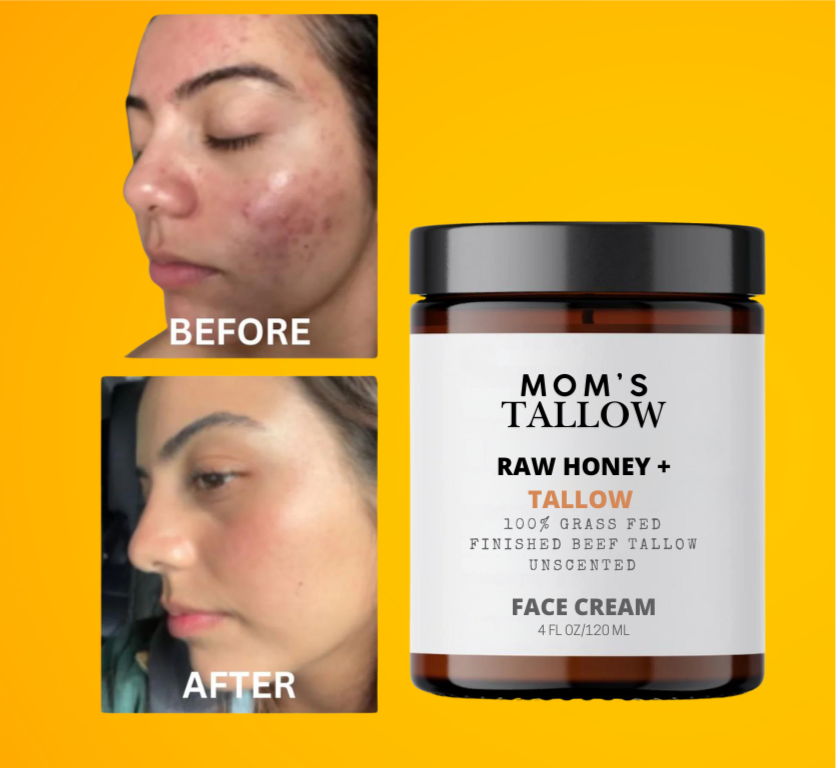 Mom’s Tallow Skin Serenity Face Cream – Nourishing Balm for Sensitive & Flaky Skin